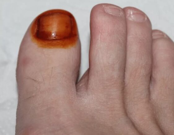 Лечение на гъбички йод