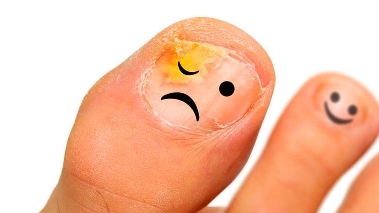 Гъбички за нокти