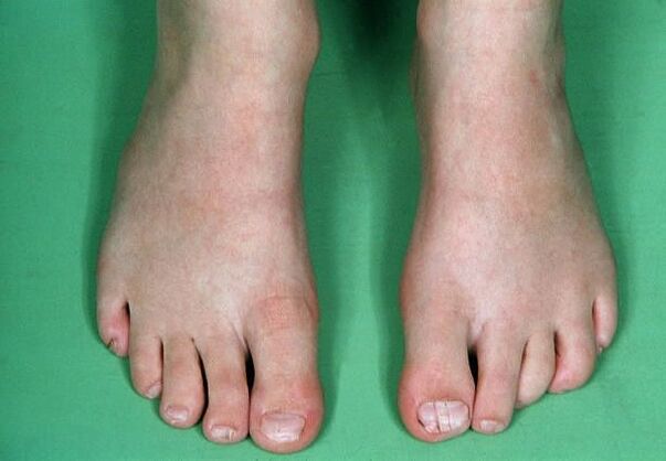 Гъбичката на краката