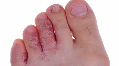 Видове и етапи на развитието на гъбички на краката