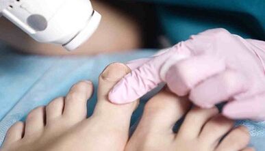 хардуерно лечение на гъбички по краката