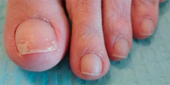 Етапи на гъбични крака