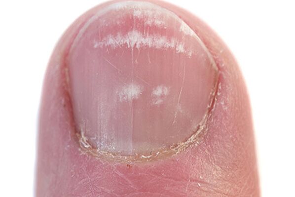 Първите признаци и симптоми