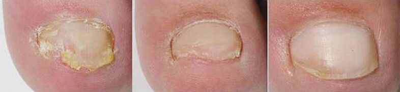 Резултати от терапията