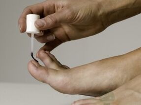 Лечение на гъбички за нокти